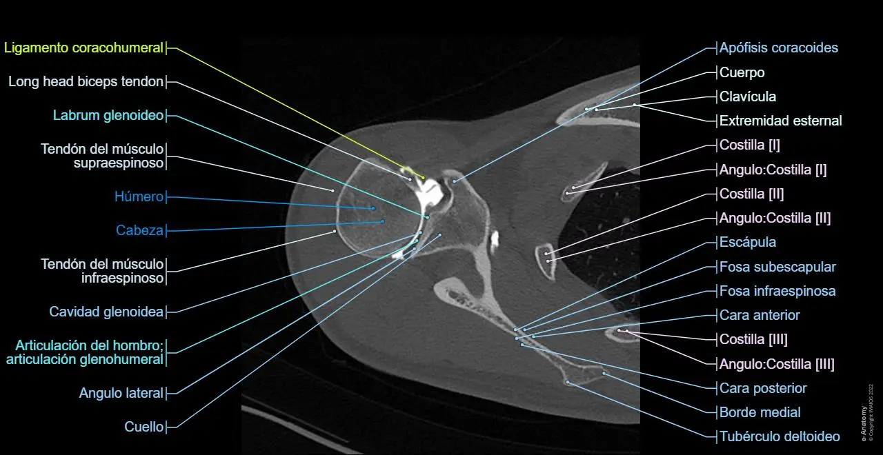 Tomografía de Hombro: Una Guía Completa - Qué se ve en una tomografía de hombro tomografia de hombro - Qué se ve en una tomografía de hombro