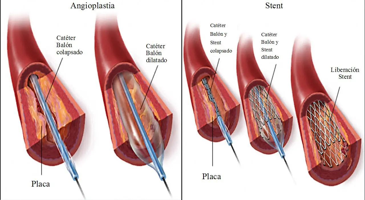 Cateterismo Cardíaco: Ventajas y Desventajas - Qué secuelas quedan después de un cateterismo ventajas y desventajas del cateterismo cardiaco - Qué secuelas quedan después de un cateterismo