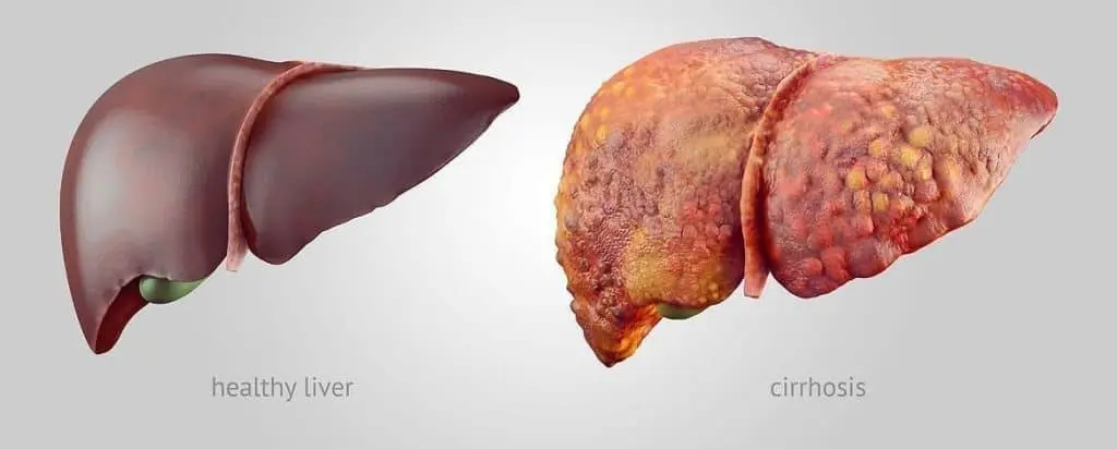 Carcinoma Hepatocelular: Una mirada a la enfermedad, sus tratamientos y la calidad de vida - Qué significa carcinoma hepatocelular carcinoma hepatocelular - Qué significa carcinoma hepatocelular