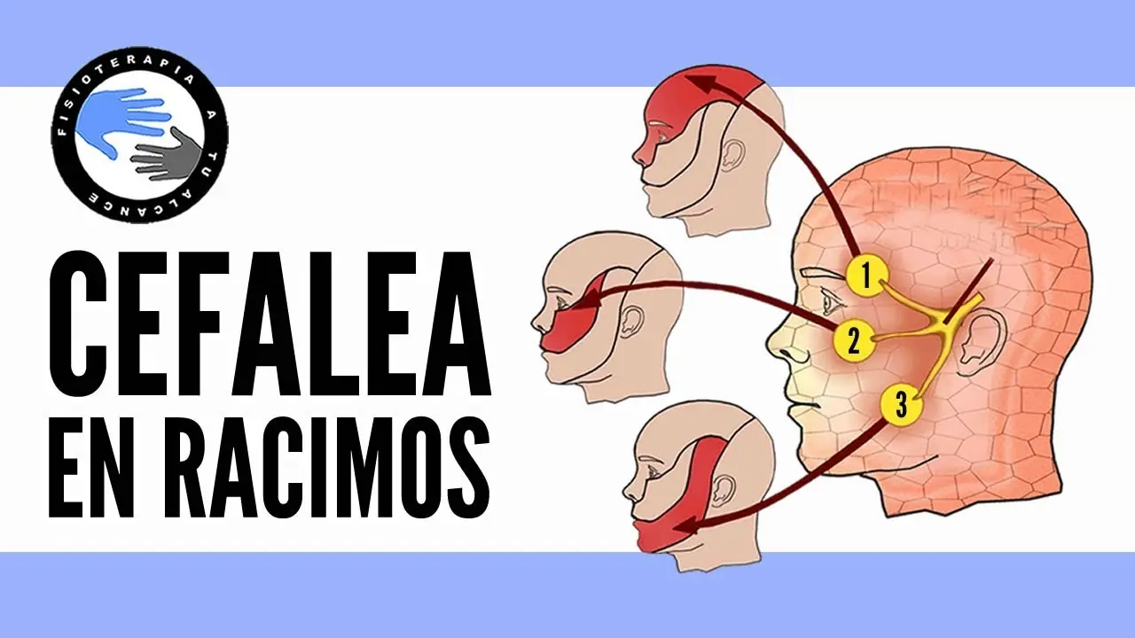 Dolor de Cabeza en Racimo: Todo lo que Necesitas Saber - Qué significa dolor de cabeza en racimo dolor de cabeza en racimo - Qué significa dolor de cabeza en racimo
