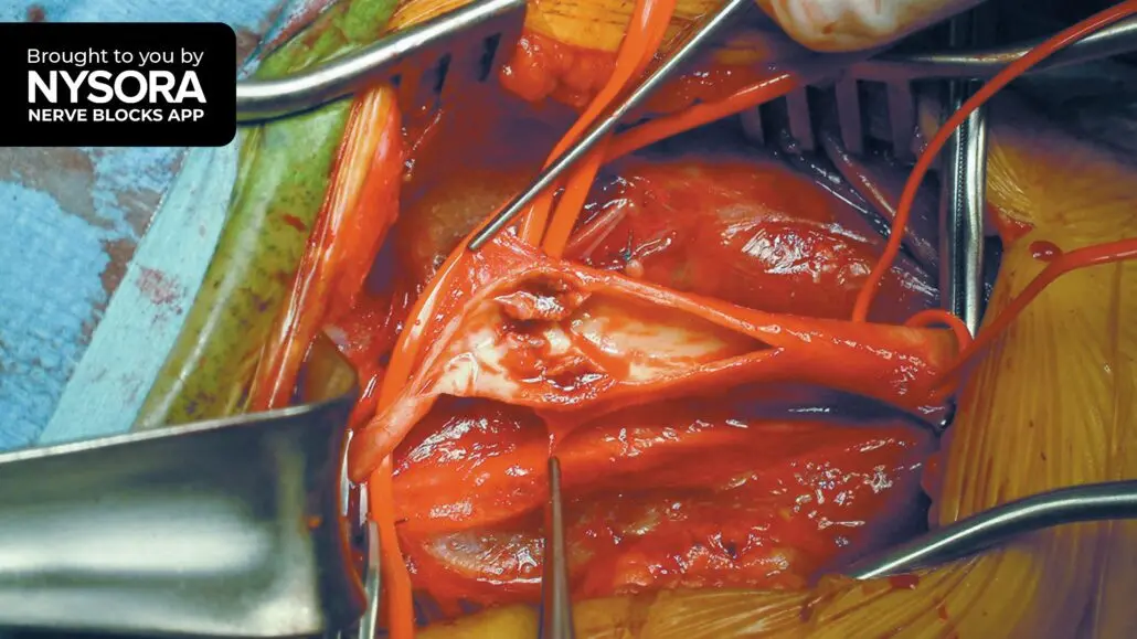 Endarterectomía Carotídea: Procedimiento, Riesgos y Recuperación - Qué significa endarterectomía carotídea endarterectomia carotidea - Qué significa endarterectomía carotídea