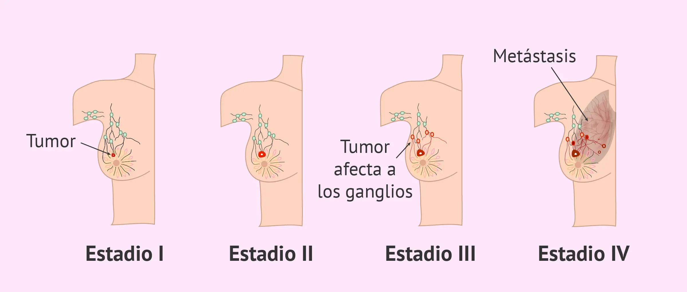 Estadificación del Cáncer de Mama: Una Guía Completa - Qué significa estadificación estadificacion cancer de mama - Qué significa estadificación