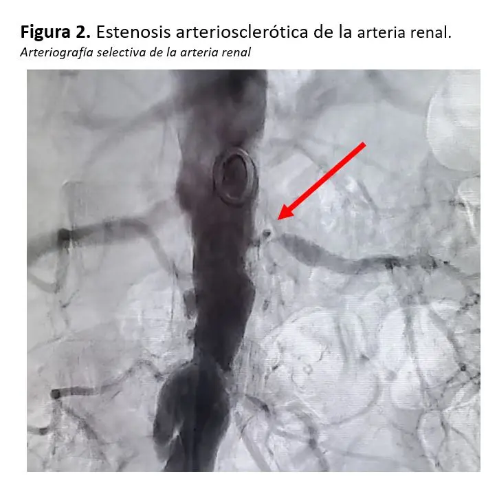 Estenosis de la Arteria Renal: Causas, Síntomas, Diagnóstico y Tratamiento - Qué significa estenosis arterial estenosis renal - Qué significa estenosis arterial