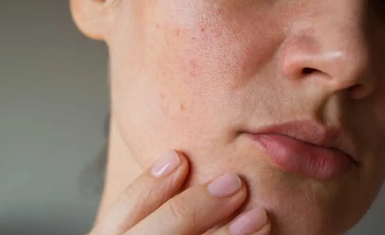 Oleosidad en el Cabello: Qué es, Causas y Cómo Controlarla - Qué significa exceso de oleosidad oleosidad - Qué significa exceso de oleosidad