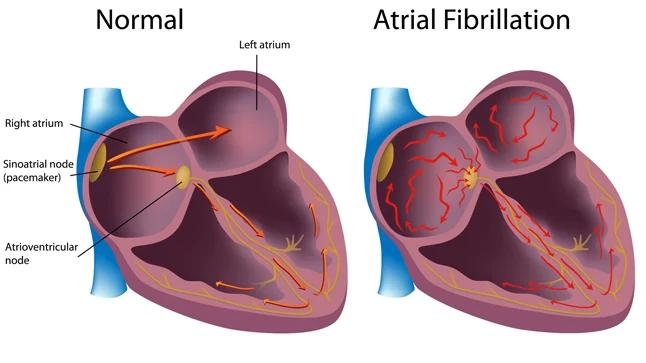 Fibrilación Auricular Paroxística: Causas, Síntomas y Tratamiento - Qué significa fibrilación auricular paroxística fibrilacion auricular paroxistica - Qué significa fibrilación auricular paroxística
