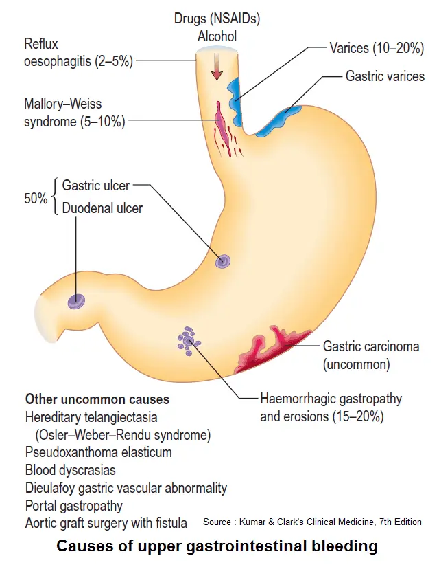 Hematemesis: Causas, Síntomas y Tratamiento - Qué significa hematemesis y melena hematemesis - Qué significa hematemesis y melena