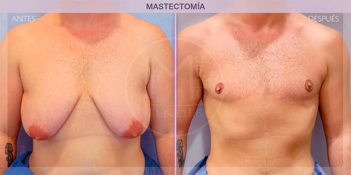 Mastectomía Bilateral: Todo lo que Debes Saber - Qué significa mastectomía bilateral mastectomia bilateral - Qué significa mastectomía bilateral