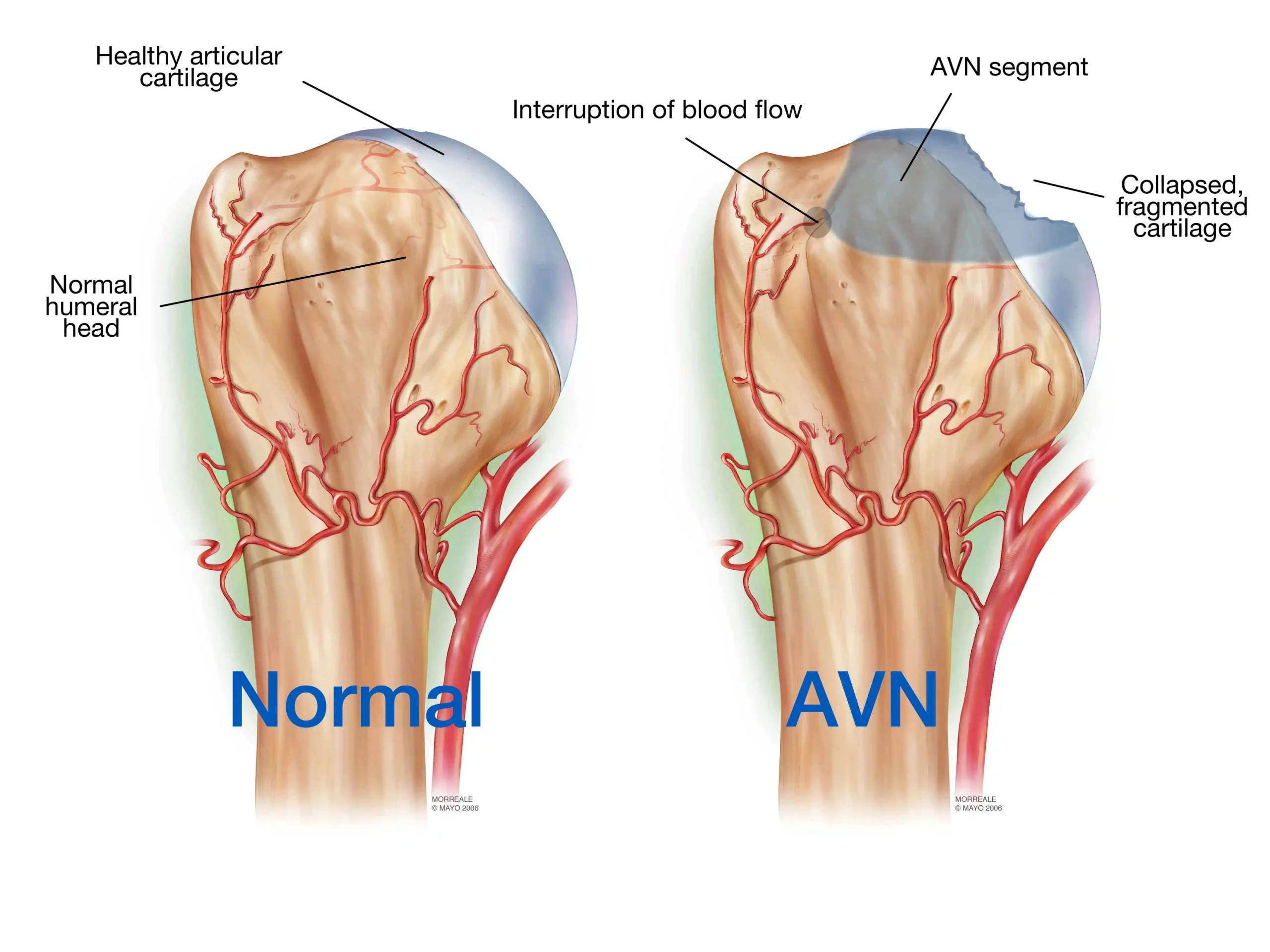 Necrosis avascular: Causas, síntomas y tratamiento - Qué significa necrosis vascular avascular necrosis - Qué significa necrosis vascular