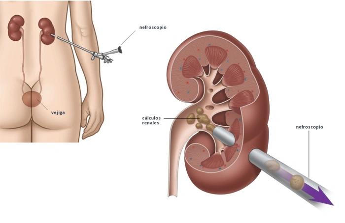 Nefrolitotomía Percutánea: Procedimiento para Extraer Cálculos Renales - Qué significa nefrolitotomia percutanea nefrolitotricia percutánea - Qué significa nefrolitotomia percutanea