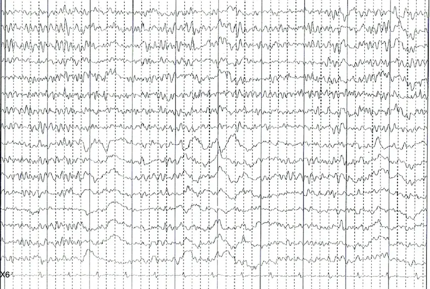 eeg de vigilia - Qué significa paciente en estado de vigilia