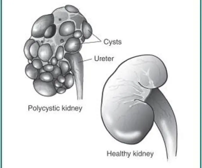 Poliquistosis Renal: Una mirada a la enfermedad hereditaria - Qué significa poliquistosis poliquistosis - Qué significa poliquistosis