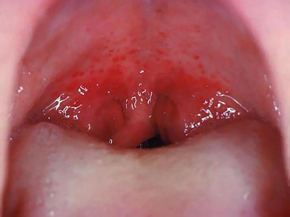 Garganta Irritada: Causas, Síntomas y Remedios - Qué significa que tenga la garganta irritada garganta irritada - Qué significa que tenga la garganta irritada