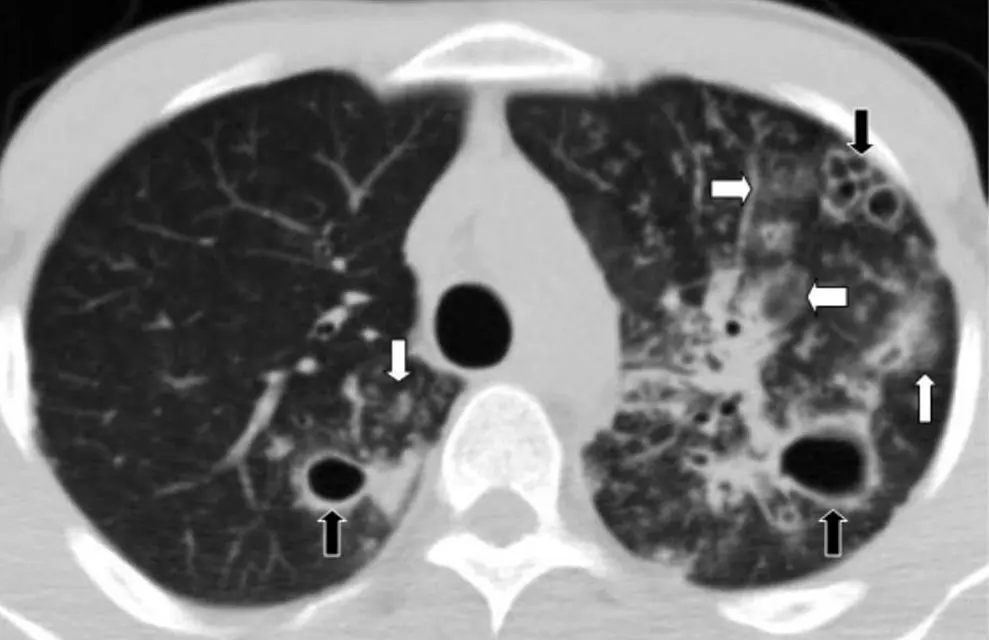 secundarismo pulmonar - Qué significa secundarismo en cáncer
