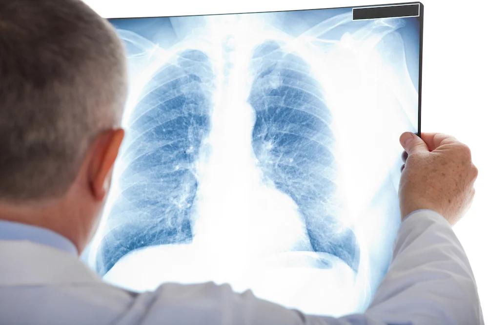 Nódulo Pulmonar: Qué Es, Tipos, Causas y Diagnóstico - Qué significa tener un nódulo que es un nodulo pulmonar - Qué significa tener un nódulo