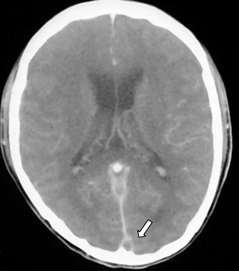 Trombosis del Seno Longitudinal Superior: Una Complicación Grave del Cerebro - Qué significa trombosis del seno longitudinal superior cerebro trombosis del seno longitudinal superior - Qué significa trombosis del seno longitudinal superior cerebro