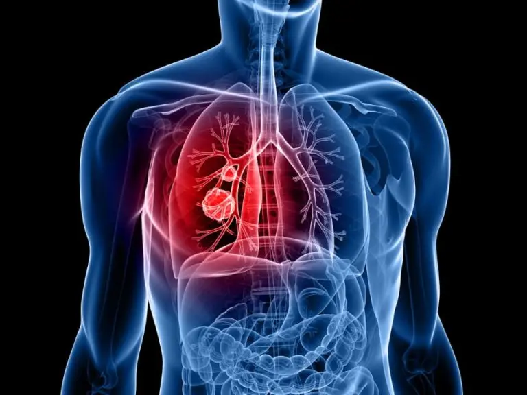 Tumor Carcinoide: Qué es, Síntomas y Tratamiento - Qué significa tumor carcinoide tumor carcinoide - Qué significa tumor carcinoide