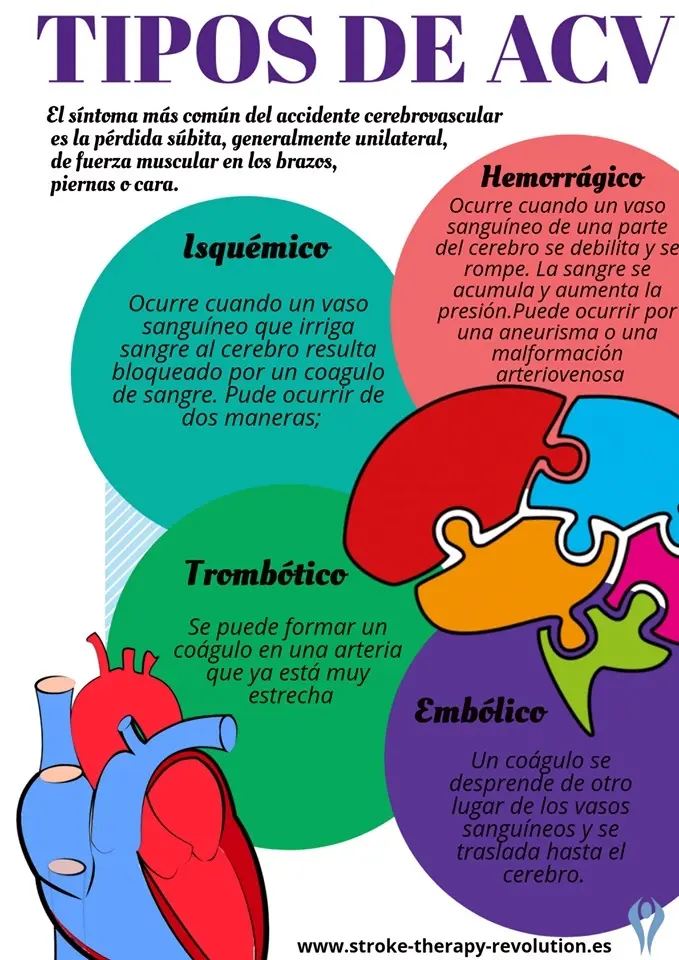 Accidente Cerebrovascular Isquémico: Definición, Causas, Síntomas y Tratamiento - Qué significa un ACV isquémico acv isquemico definicion - Qué significa un ACV isquémico