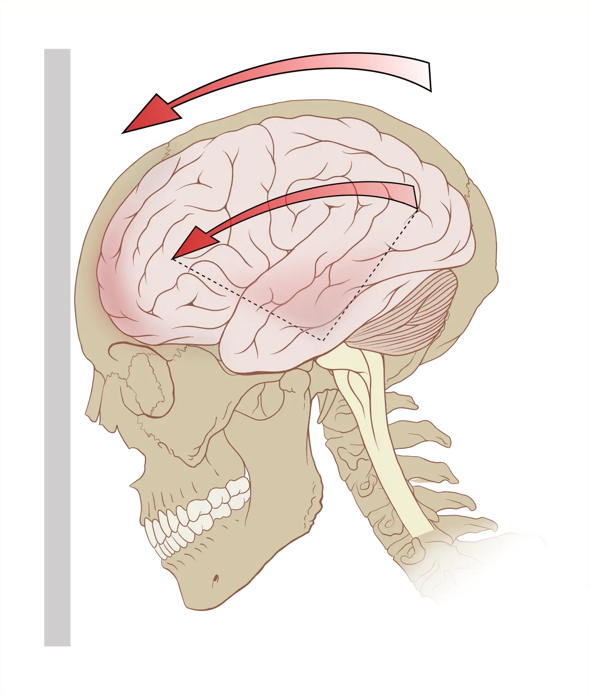 Concusión: Definición, Causas, Síntomas y Tratamiento - Qué significa una concusión concusion - Qué significa una concusión