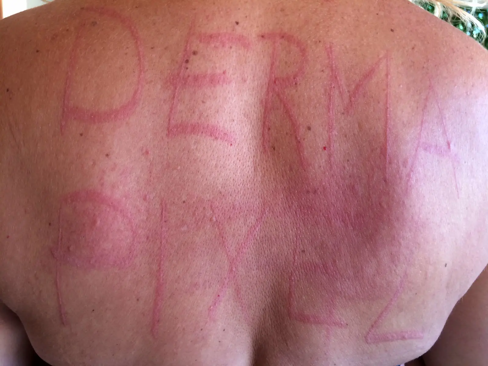 Urticaria Colinérgica: Causas, Síntomas y Tratamiento - Qué significa urticaria colinérgica urticaria facticia - Qué significa urticaria colinérgica