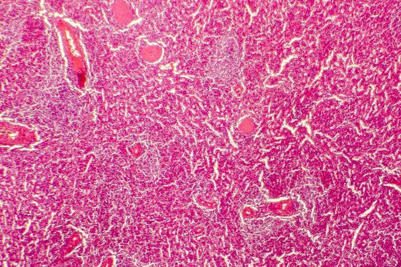 Degeneración Hialina: Un Fenómeno Común en los Leiomiomas Uterinos - Qué significan las degeneraciones hialinas meniscales degeneracion hialina - Qué significan las degeneraciones hialinas meniscales