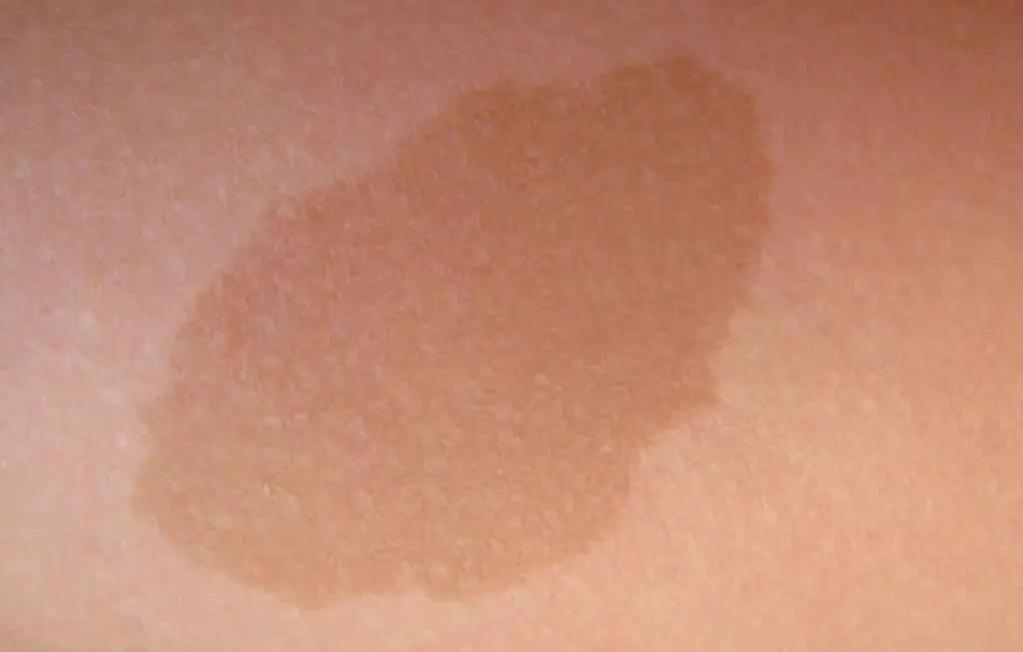 Manchas en la Piel de los Niños: Causas, Síntomas y Diagnóstico - Qué significan manchas cafés en la piel de un niño manchas en la piel niños - Qué significan manchas cafés en la piel de un niño