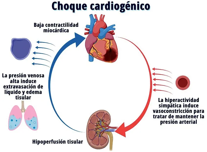 Shock Cardiogénico: Causas, Síntomas, Diagnóstico y Tratamiento - Qué signos y síntomas presenta un paciente con shock carcinogénico shock cardiogenico - Qué signos y síntomas presenta un paciente con shock carcinogénico