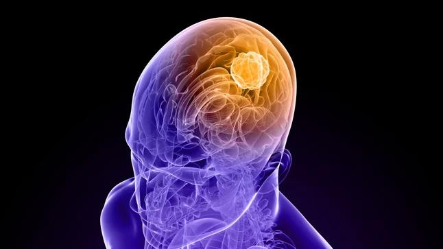 Tumores Cerebrales en Niños: Síntomas, Tipos y Diagnóstico - Qué síntomas tiene un niño con tumor en la cabeza tumor cerebral en niños - Qué síntomas tiene un niño con tumor en la cabeza