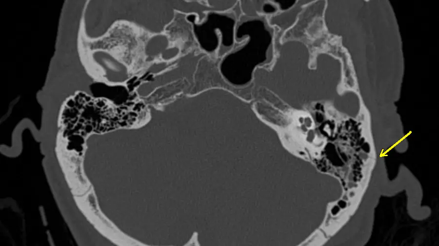 Fractura de la base del cráneo: causas, síntomas, diagnóstico y tratamiento - Qué sucede con una fractura de la base del cráneo fractura de base de craneo - Qué sucede con una fractura de la base del cráneo