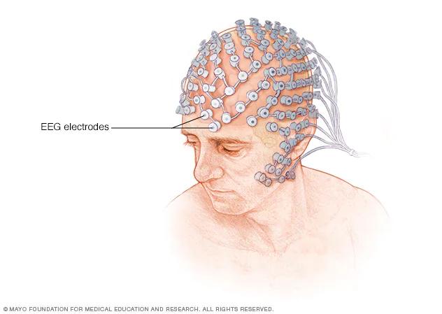 Electroencefalograma (EEG): Qué sucede después de la prueba - Qué sucede después de un EEG eeg - Qué sucede después de un EEG