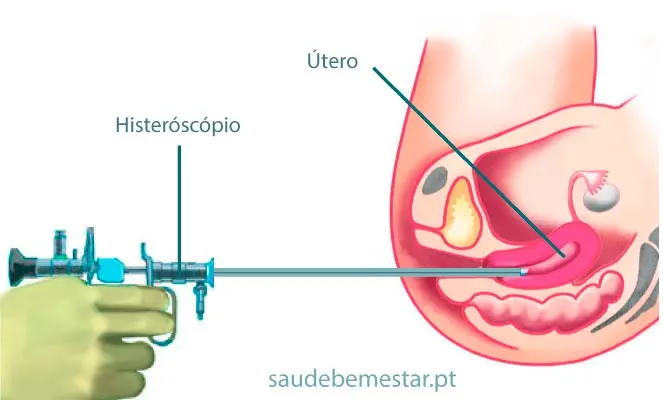 Histeroscopia: Una guía completa sobre este procedimiento - Qué tan dolorosa es la histeroscopia histerectoscopia - Qué tan dolorosa es la histeroscopia