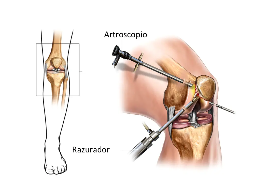 Artroscopia simple de rodilla: Todo lo que necesitas saber - Qué tan efectiva es una artroscopia de rodilla artroscopia simple de rodilla - Qué tan efectiva es una artroscopia de rodilla