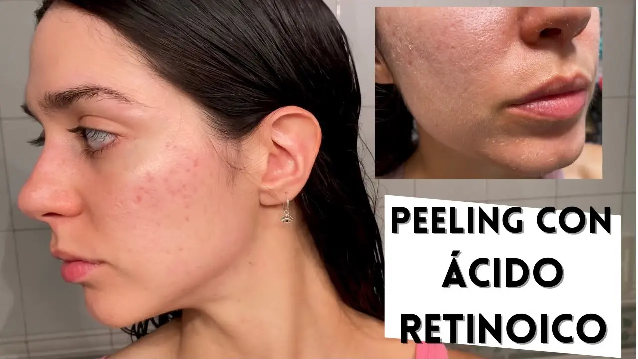 Ácido Retinoico para Manchas: La Guía Definitiva para un Rostro Radiante - Qué tan efectivo es el ácido retinoico para las manchas acido retinoico para manchas - Qué tan efectivo es el ácido retinoico para las manchas