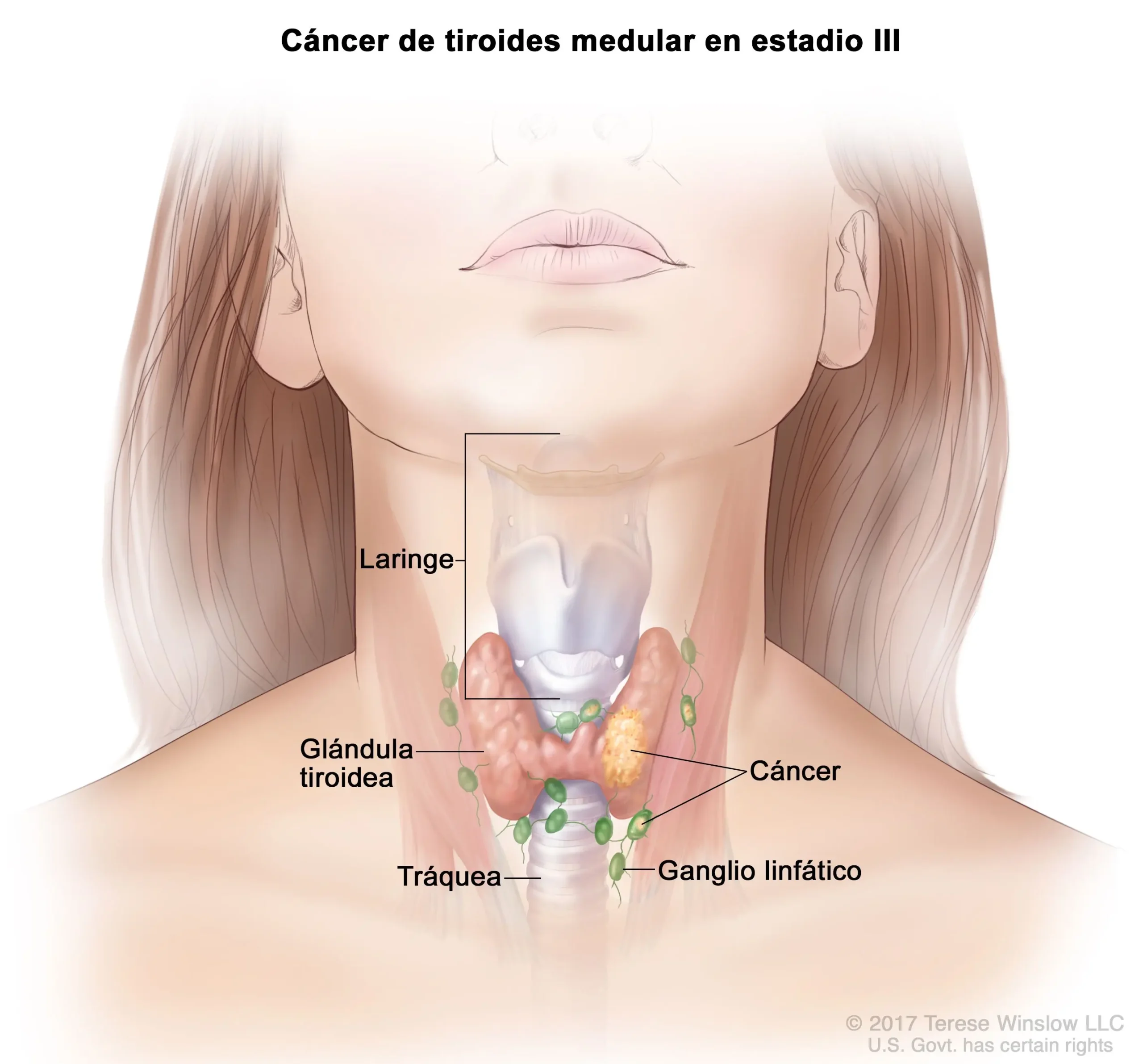 carcinoma medular de tiroides - Qué tan grave es el cáncer medular de tiroides