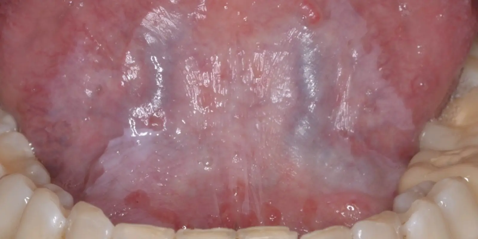 Leucoplasia Oral: Causas, Síntomas, Tipos y Tratamiento - Qué tan grave es la leucoplasia leucoplasia oral - Qué tan grave es la leucoplasia
