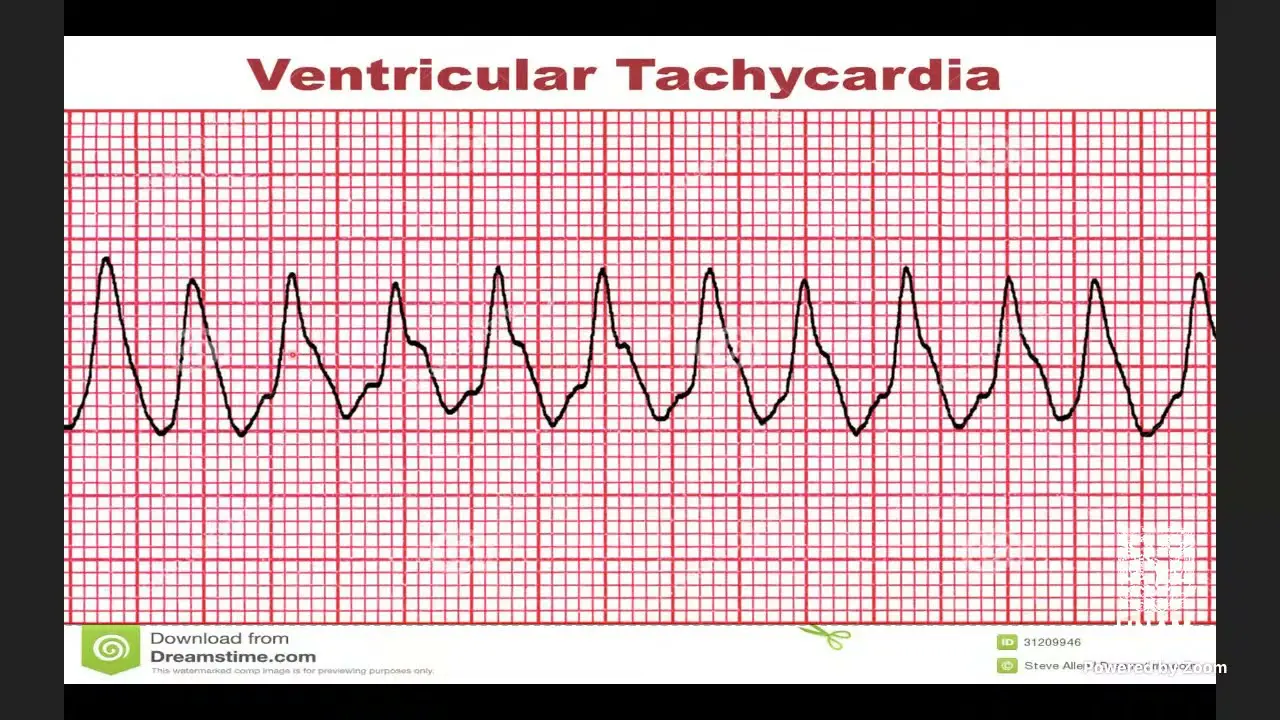 Taquicardia Ventricular: Causas, Diagnóstico y Tratamiento - Qué tan grave es la taquicardia taquicardia ventricular - Qué tan grave es la taquicardia