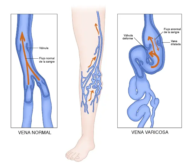 Enfermedades Vasculares: Causas, Síntomas y Tratamiento - Qué tan grave es un problema vascular insuficiencia vascular - Qué tan grave es un problema vascular