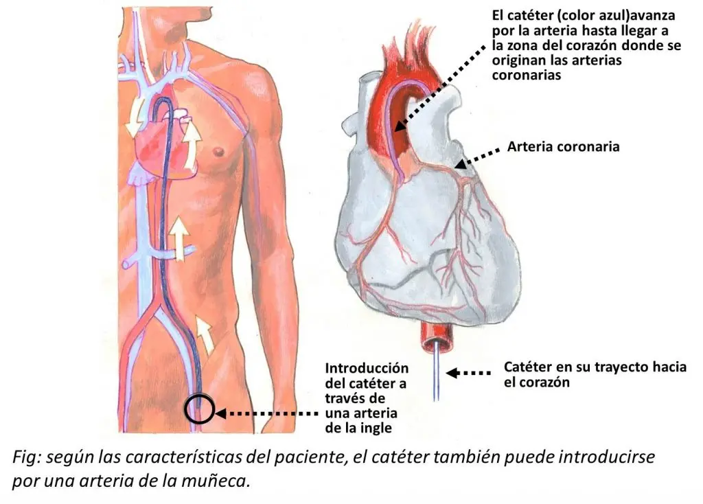 Cateterismo Cardíaco: Qué es, para qué sirve y qué esperar - Qué tan invasivo es un cateterismo cateterismo cardiaco que es y para que sirve - Qué tan invasivo es un cateterismo