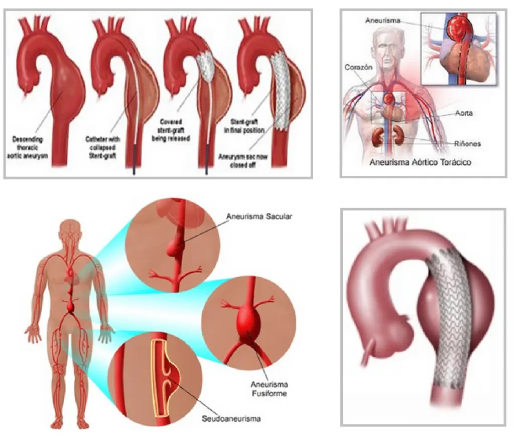 Aneurisma de Aorta Torácica: Diagnóstico, Tratamiento y Riesgos - Qué tan peligroso es un aneurisma en la aorta aneurisma de aorta toracica - Qué tan peligroso es un aneurisma en la aorta
