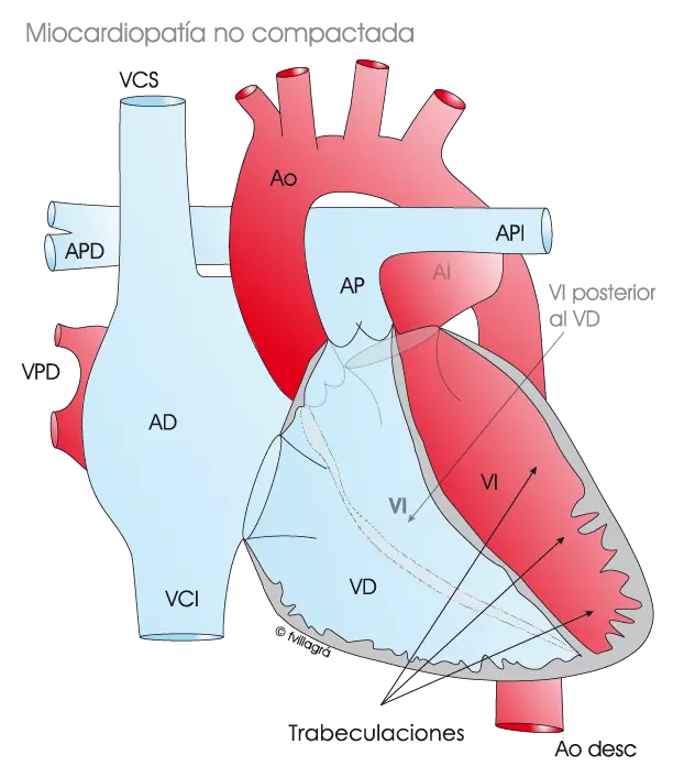 Miocardiopatía No Compactada: Una Mirada a la Rara Condición Cardiaca - Qué tan rara es la no compactación del ventrículo izquierdo miocardiopatia no compactada - Qué tan rara es la no compactación del ventrículo izquierdo