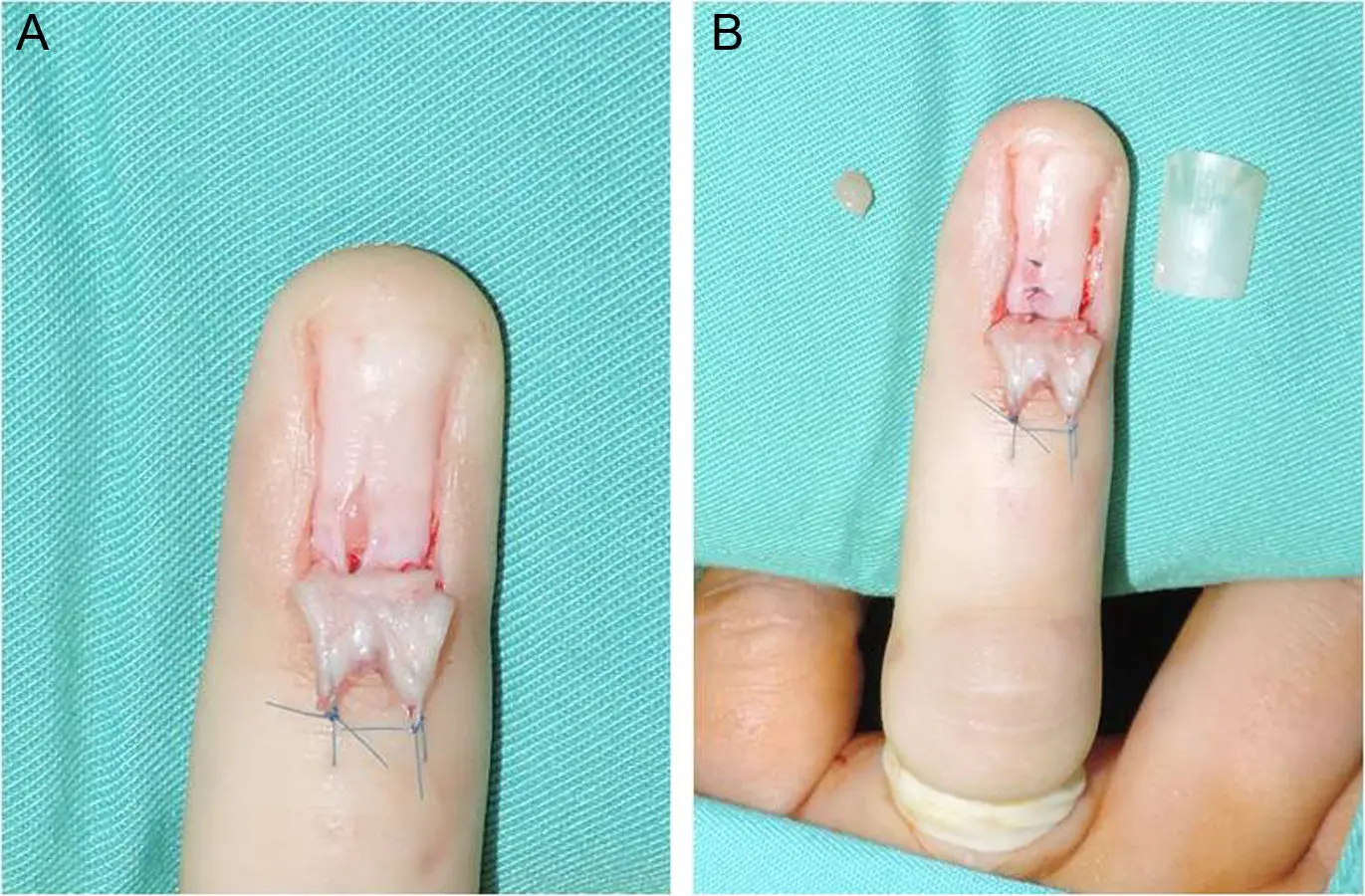 Tumores Glómicos: Una Mirada Detallada - Qué tan raro es un tumor glómico tumores glómicos - Qué tan raro es un tumor glómico