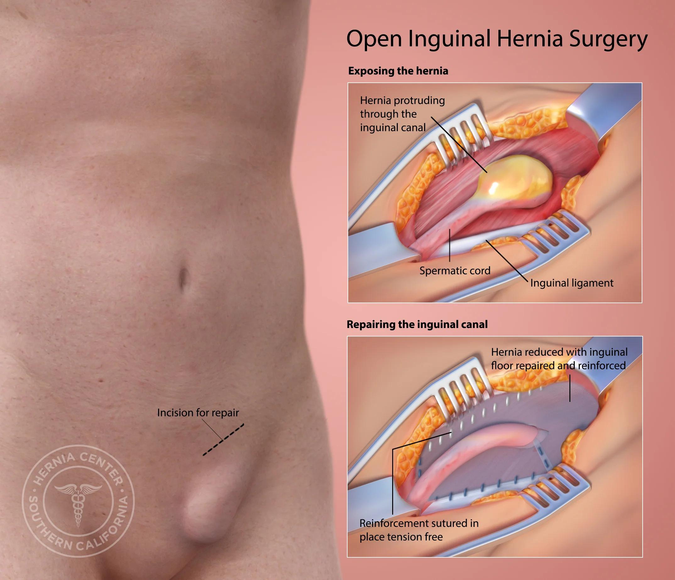 Cirugía de Hernia: Riesgos y Aspectos a Considerar - Qué tan riesgosa es la cirugía de hernia cirugia de hernia - Qué tan riesgosa es la cirugía de hernia