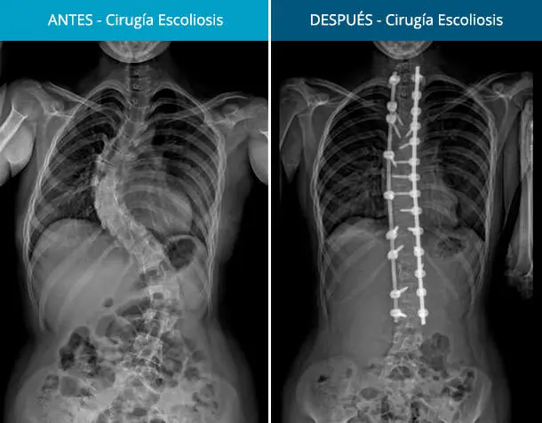 Cirugía de Escoliosis: Riesgos, Procedimientos y Recuperación - Qué tan riesgosa es una cirugía de escoliosis cirugia escoliosis - Qué tan riesgosa es una cirugía de escoliosis