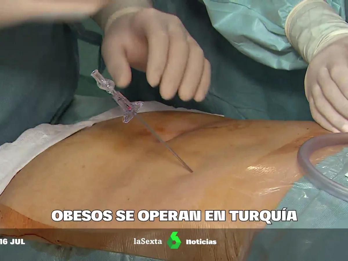 Operaciones de estómago: Tipos, Riesgos y Resultados - Qué tan riesgosa es una cirugía de estómago operacion de estomago - Qué tan riesgosa es una cirugía de estómago