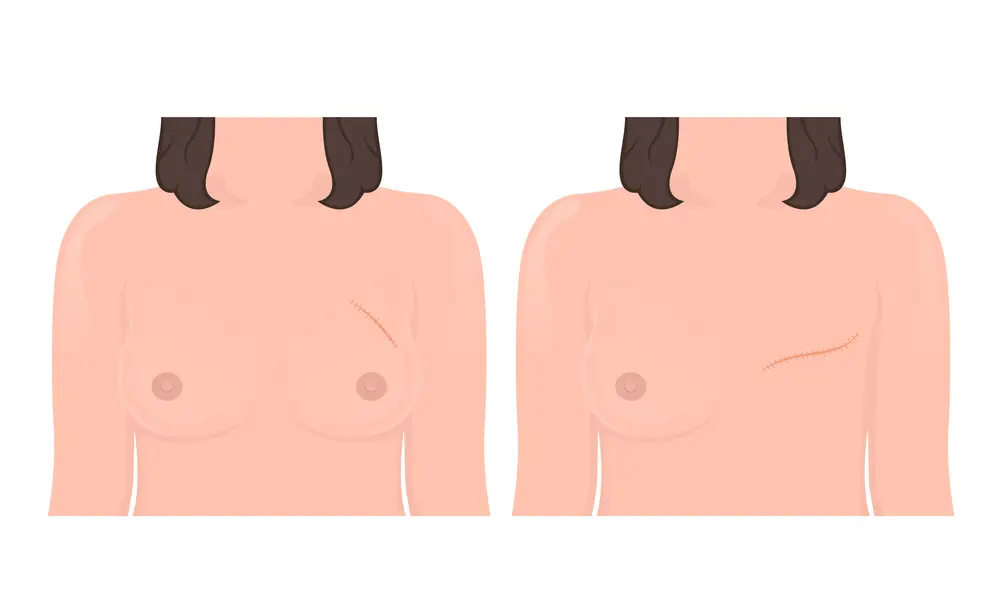 Mastectomía Bilateral: Todo lo que Debes Saber - Qué tan riesgosa es una mastectomía mastectomia bilateral - Qué tan riesgosa es una mastectomía