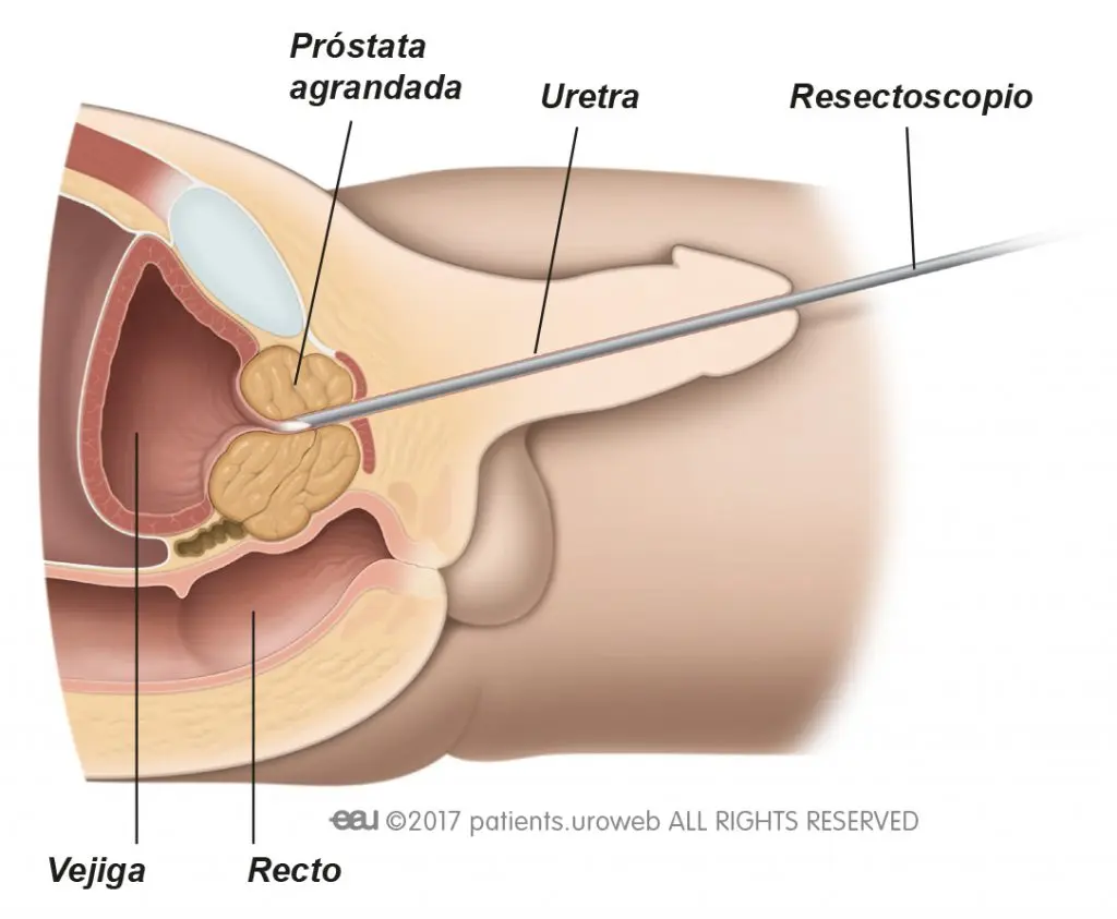 Operación de Próstata: Guía Completa para Pacientes - Qué tan riesgosa es una operación de próstata operacion de prostata - Qué tan riesgosa es una operación de próstata