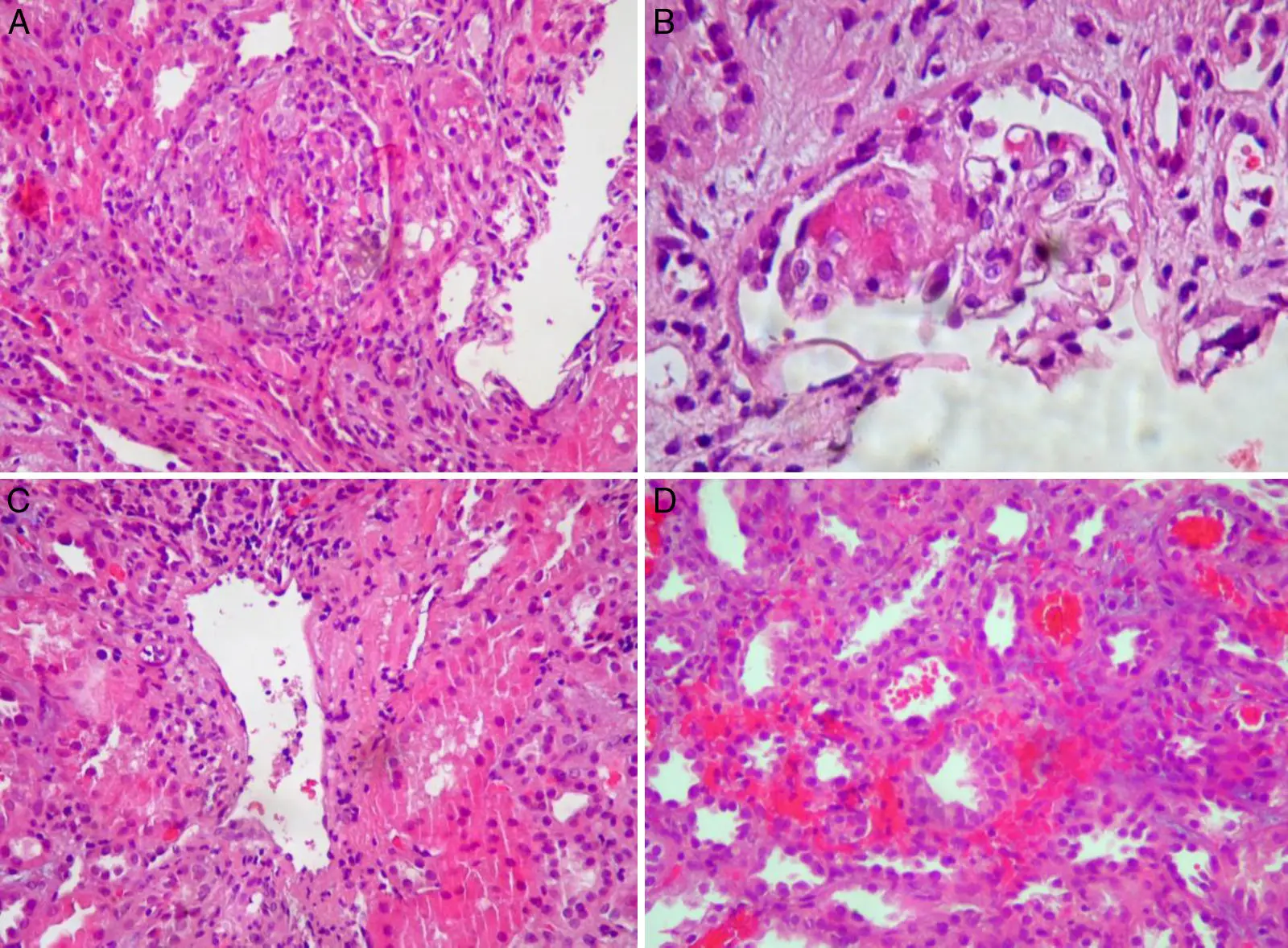 Granulomatosis con Poliangeítis (de Wegener): Causas, Síntomas, Diagnóstico y Tratamiento - Qué tipo de anticuerpo es más característico de la enfermedad de Wegener granulomatosis de wegener - Qué tipo de anticuerpo es más característico de la enfermedad de Wegener