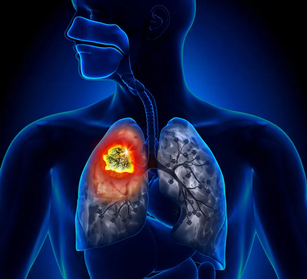 Cuánto tiempo vive una persona con cáncer de pulmón avanzado: Explorando el pronóstico y la supervivencia - Qué tipo de cáncer de pulmón es el más agresivo cancer de pulmon avanzado - Qué tipo de cáncer de pulmón es el más agresivo