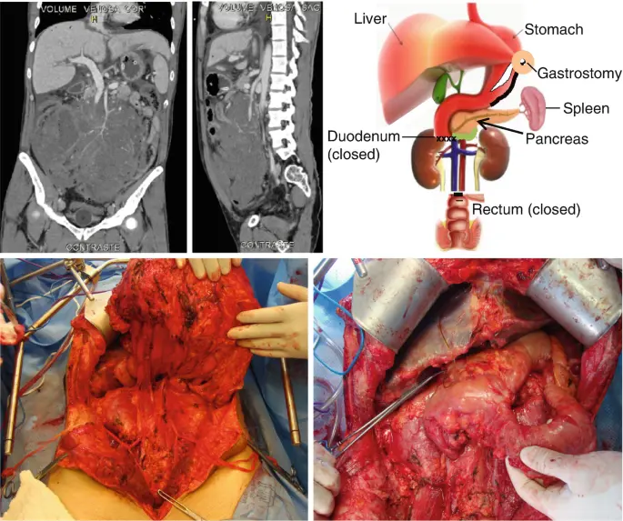 Tumor Retroperitoneal: Un Reto para la Salud - Qué tipo de cáncer es retroperitoneal tumor retroperitoneal - Qué tipo de cáncer es retroperitoneal