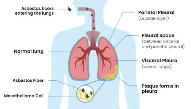 El Derrame Pleural y su Relación con el Cáncer: Una Guía Completa - Qué tipo de cáncer provoca derrame pleural pleural cancer - Qué tipo de cáncer provoca derrame pleural