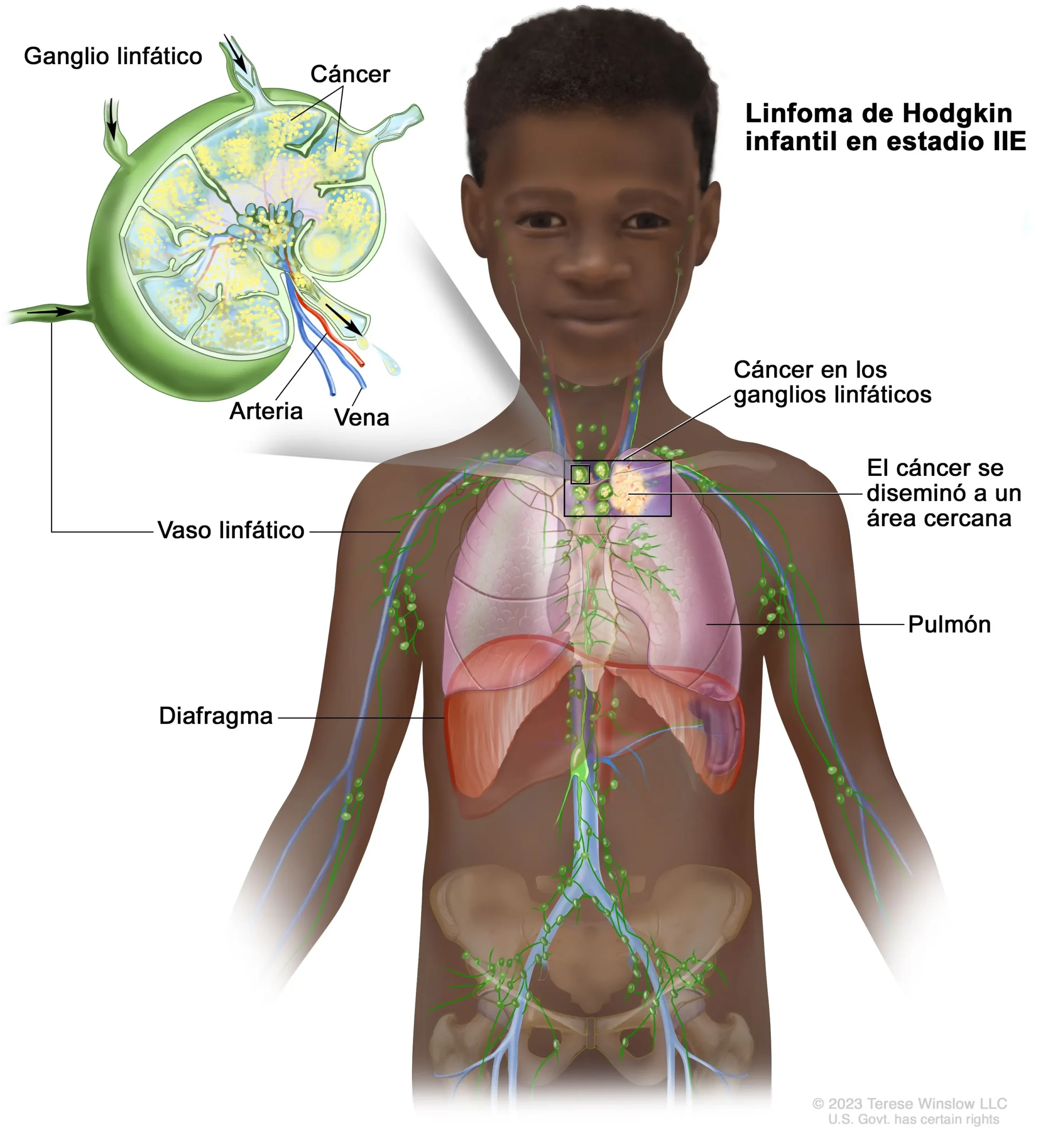 Linfoma de Hodgkin en Niños: Diagnóstico, Síntomas y Tratamiento - Qué tipo de linfoma es más frecuente en niños linfoma de hodgkin en niños - Qué tipo de linfoma es más frecuente en niños